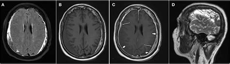 Acute Subdural Hematoma Mri