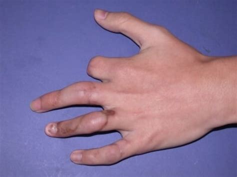 Replantation | Hand Surgery Associates