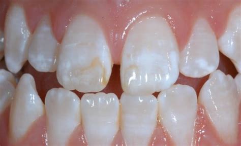 Tooth Enamel Defects Clayton - 3 Fixes | Clarinda Clinic