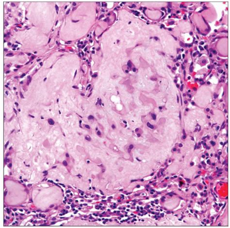 Epithelioid Hemangioendothelioma | Basicmedical Key