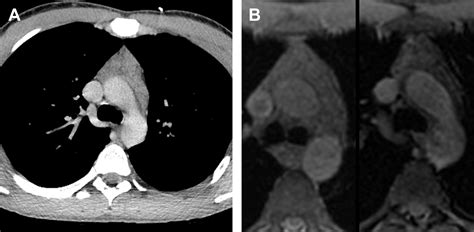 Imaging of the Anterior/Prevascular Mediastinum | Radiology Key