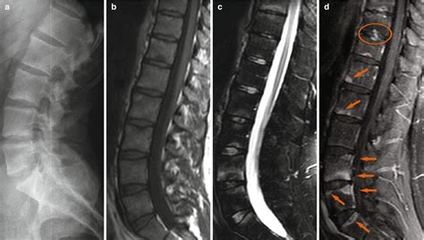 Ankylosing Spondylitis CT Scan