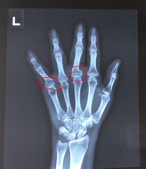 Broken Finger X Ray