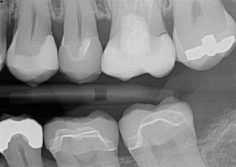 Another Lightwalker laser one-piece e.Max crown removal | CDOCS