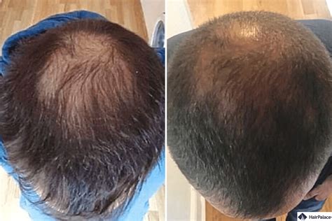 Stem cell hair transplant: what is it, how does it work?