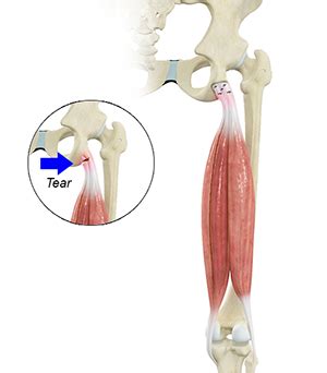 Hamstring Tendon