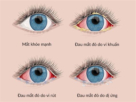 Các nguyên nhân dẫn tới bệnh đau mắt đỏ (viêm kết mạc) và cách điều trị