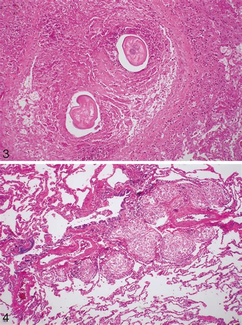 Pathology of Granulomatous Pulmonary Diseases | Archives of Pathology & Laboratory Medicine