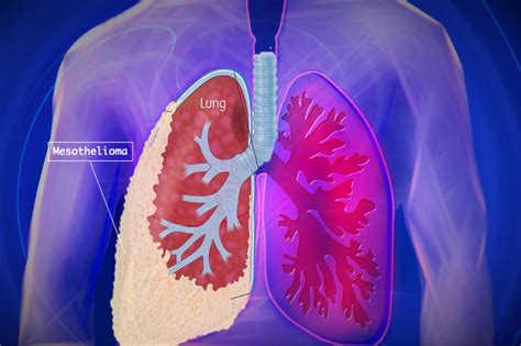 Can These Breakthrough Therapeutics win the fight against Mesothelioma? | Avise Analytics