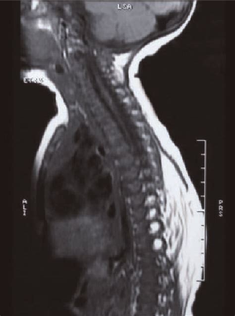 Axial MRI view demonsrating the mass which belonging to... | Download Scientific Diagram