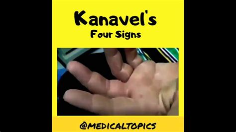 kanavel's four signs - YouTube