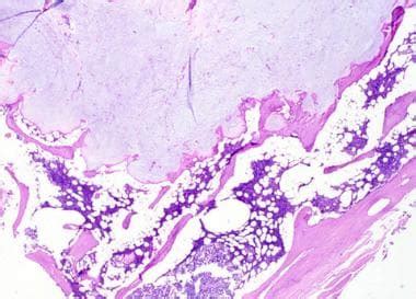 Enchondroma Pathology: Definition, Epidemiology, Etiology