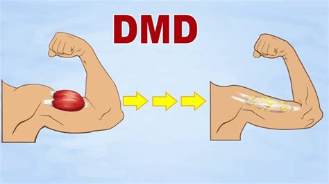 Duchenne muscular dystrophy (DMD) : Cause, Symptoms, Physiotherapy