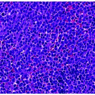 Myxoid liposarcoma showing different stages of primitive fat cells.... | Download Scientific Diagram