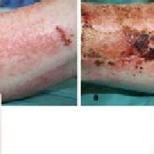 Case 2. Wound appearance at day 21. Discharge from hospital | Download Scientific Diagram