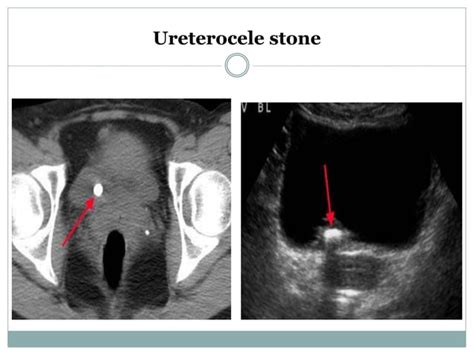 Ectopic ureter & ureterocoele