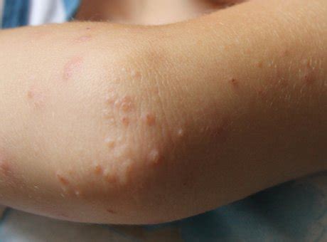 Small Raised Bumps on Elbows: Causes and Prevention | IYTmed.com