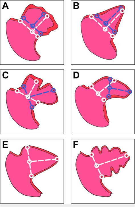 Left atrial appendage morphology and measurement error (A) Cauliflower ...