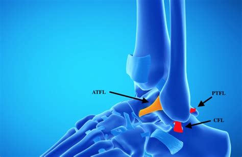 Ankle stabilisation Surgery | Dr. Mike Smith | Adelaide Ankle Surgeon