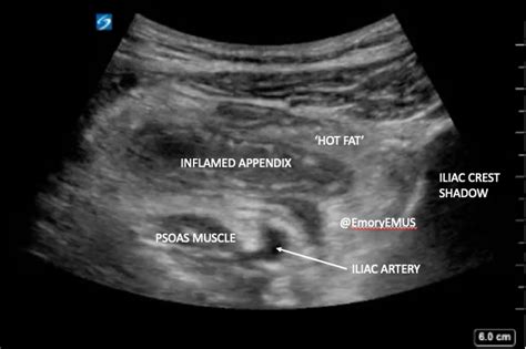 Right Lower Quadrant Pain | Emory School of Medicine