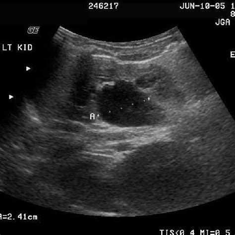 Antenatal ultrasound of fetus demonstrating “keyhole” sign indicative ...