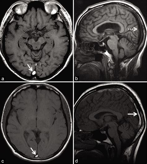 Transverse Sinus Mri