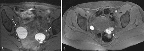 Endometriosis | Radiology Key