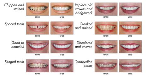 Veneers For Overlapping Teeth - veneers 2020