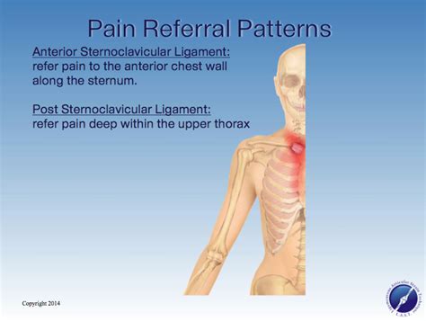 (Video Inside) Research on Sternoclavicular Pain? - LASTechnique