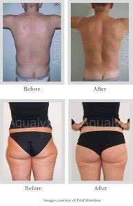 aqualyx-before-after - rtwskin aesthetics clinic