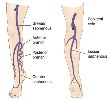 Great and small saphenous veins insufficiency Montreal treatment