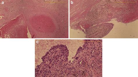 (a) Pathology slides demonstrating fresh and old hemosiderin deposition... | Download Scientific ...