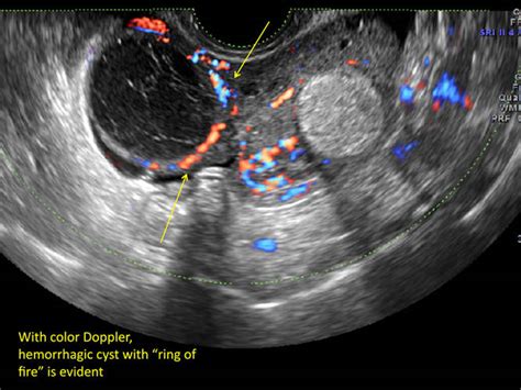 Hemorrhagic ovarian cysts: One entity with many appearances | MDedge ObGyn