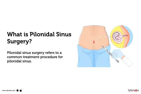 Pilonidal Sinus Surgery: Purpose, Procedure, Benefits and Side Effects