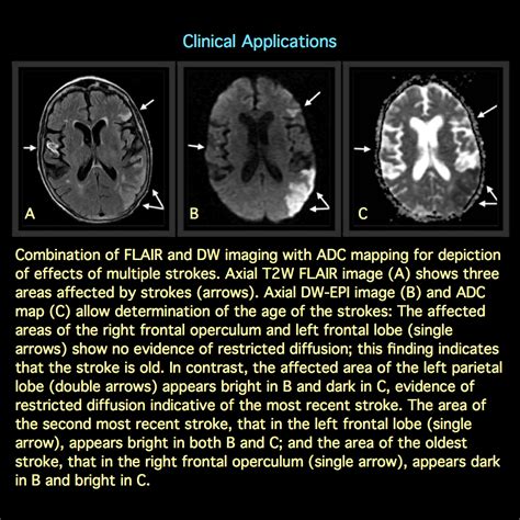 MRI BLOG: Diffusion-weighted MR Imaging