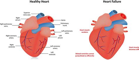 Congestive heart failure (CHF) in dogs and cats