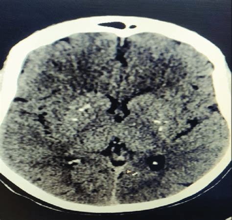 CT head showing bilateral basal ganglia calcification | Download ...