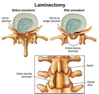 Lumbar Foraminotomy