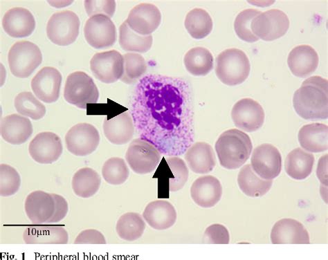 Occurrence of neutrophil dysplasia in the course of severe nephrotic syndrome in a 12-year-old ...