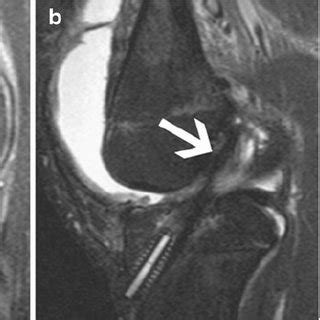 Summary of MRI findings | Download Table