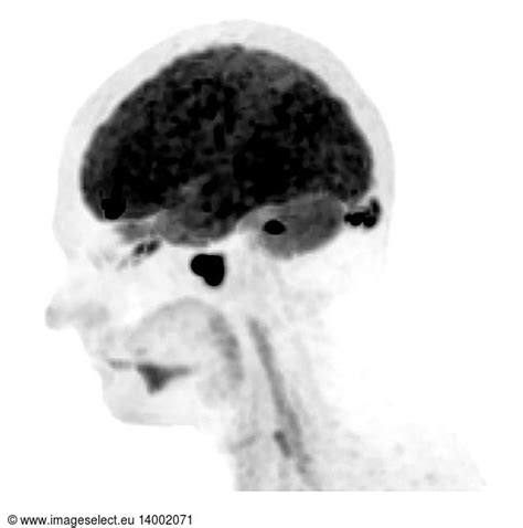 PET Scan Lymphoma PET Scan Lymphoma,abnormal pet scan,abnormal,abnormality,b-cell lymphoma ...