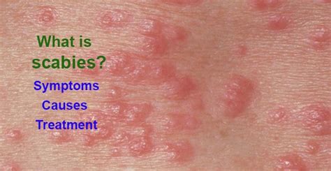 What is scabies? Symptoms, causes, treatment and home remedies