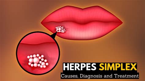 Herpes Simplex, Causes, Signs and Symptoms, Diagnosis and Treatment. - YouTube