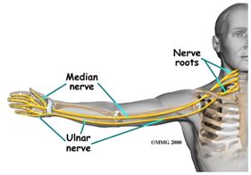 Pinched Nerve Treatment - Neck & Arm Pain Therapy