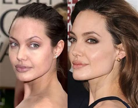 Angelina Jolie Plastic Surgery Before and After Botox Injections | Celebie