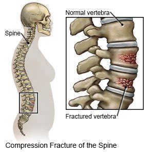 Vertebral Compression Fracture - What You Need to Know