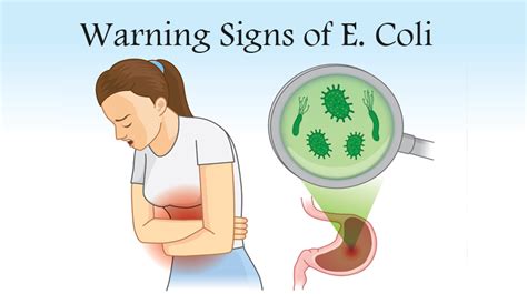 7 Warning Signs It’s Not Just a Stomachache: It Could Be E. Coli - WomenWorking