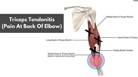 Lifters Elbow Pain - Triceps Tendonitis (A Helpful Guide)