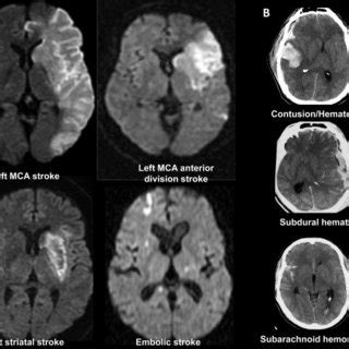 (PDF) Vascular Parkinsonism: Deconstructing a Syndrome