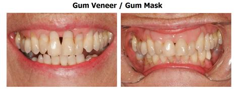 Gingival veneers | News | Periodontal disease treatment, Dentistry, Periodontal disease